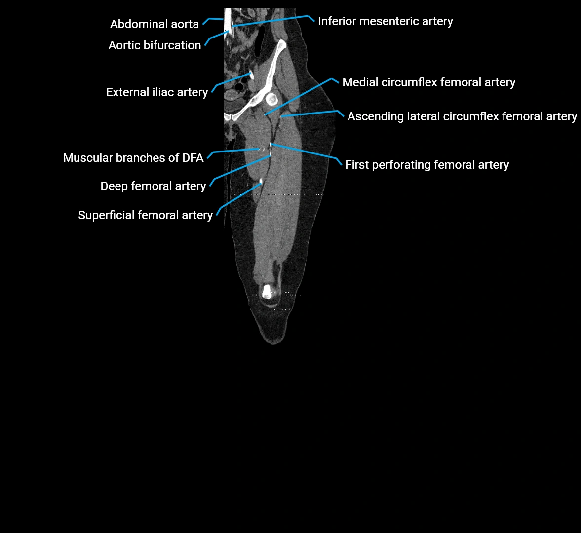 CTA lower limb coronal cross sectional anatomy labelled image _25 (3).webp